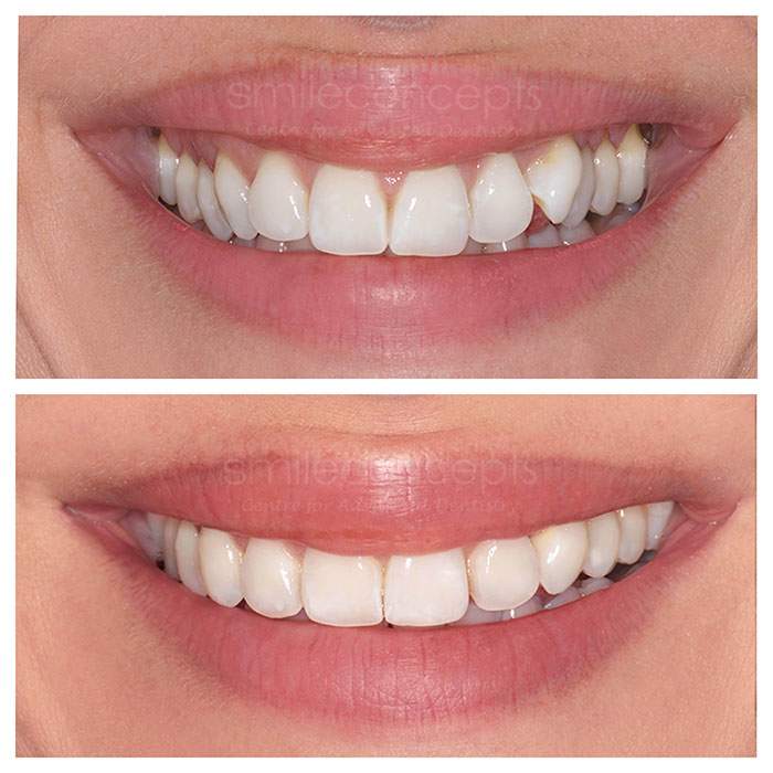 invisalign treatment at clear braces orthodontics