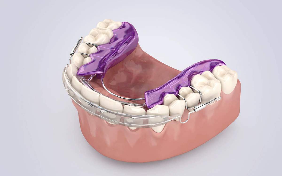 Inman Aligner Sydney Clear Aligner Braces for Adults Clear Braces