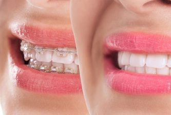 Adult Orthodontics Sydney