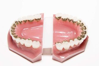 Lingual Braces for Adults