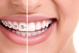 Invisalign clear braces orthodontics