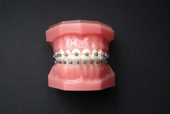 metal braces