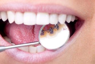 Invisible Braces Sydney